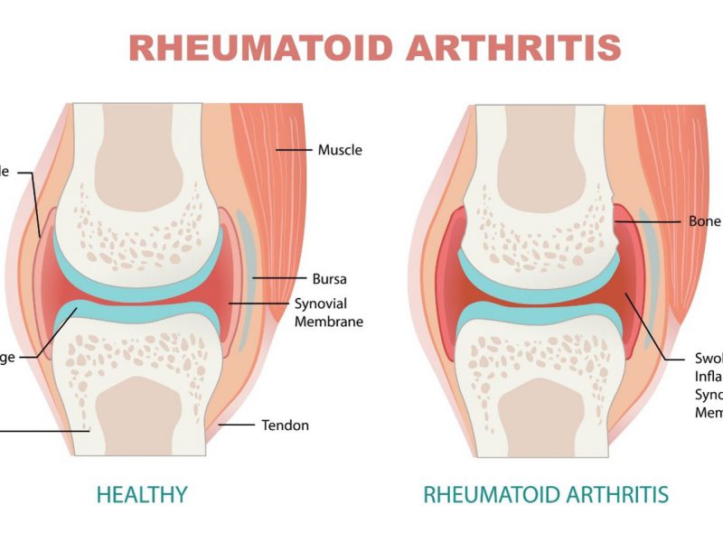 Rheumatoid Arthritis